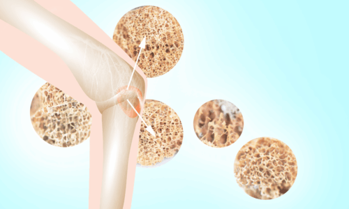 Dem Bones, them Bones, them Healthy Bones